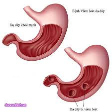 xuat-huyet-da-day