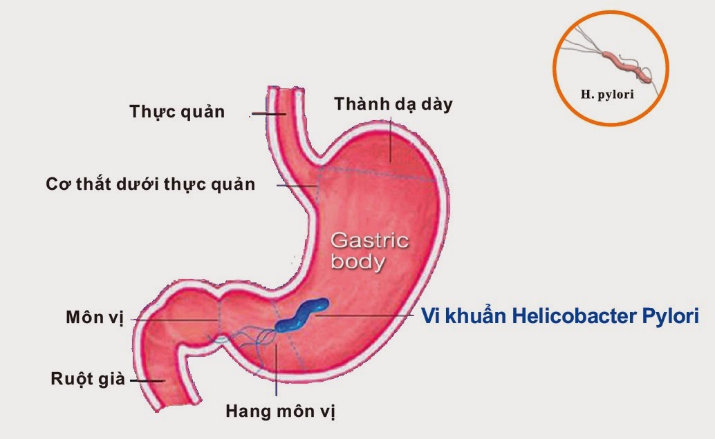 lam-gi-khi-bi-viem-da-day-do-vi-khuan-hp