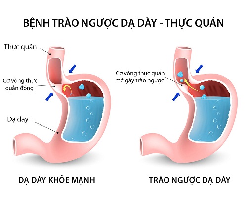 Résultat de recherche d'images pour "trào ngược dạ dày"