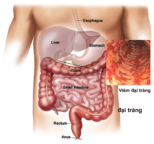 dau-hieu-nhan-biet-som-benh-viem-dai-trang
