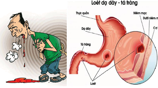 so-cap-cuu-xuat-huyet-da-day-ta-trang2