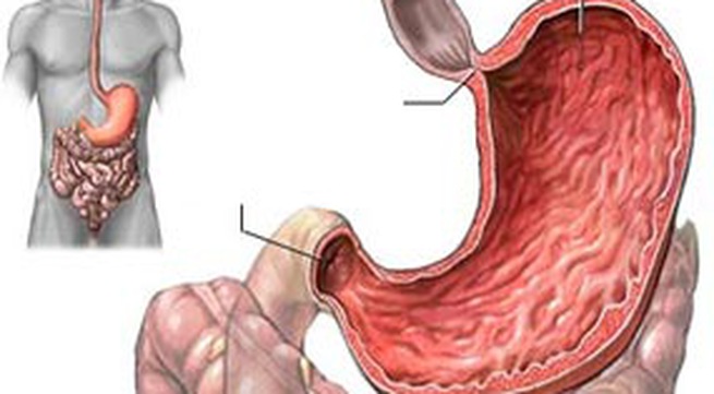 Rối loạn chức năng dạ dày do giãn dạ dày cấp