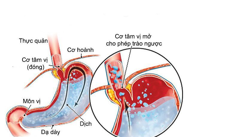 Có thắt môn vị dạ dày gây rối loạn chức năng dạ dày