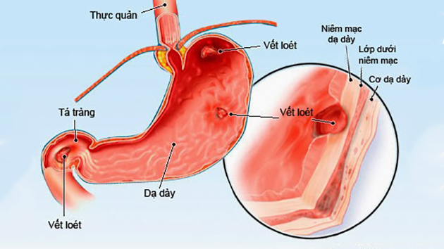 Tăng toan gây rối loạn chức năng dạ dày