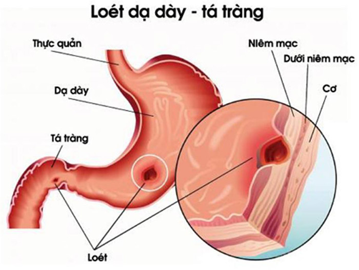 Nhận biết viêm dạ dày qua màu phân