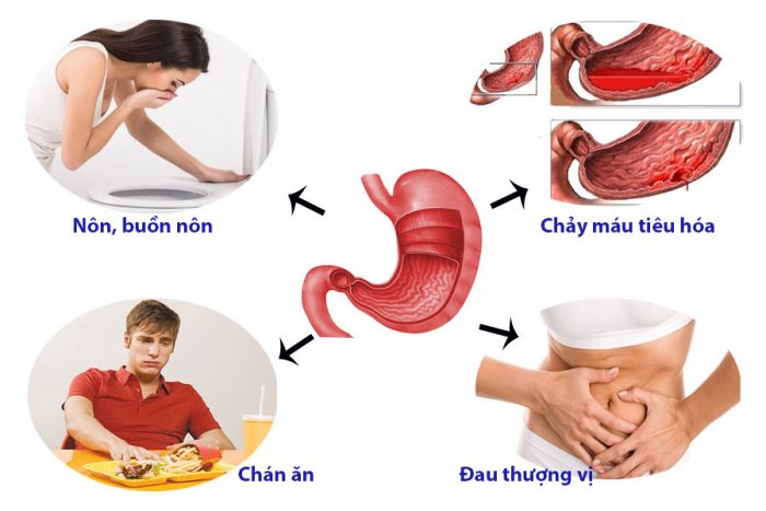 Viêm dạ dày ung thư dạ dày dễ nhầm lẫn