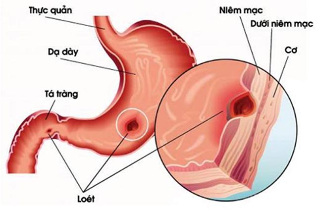 Bệnh viêm loét dạ dày mãn tính