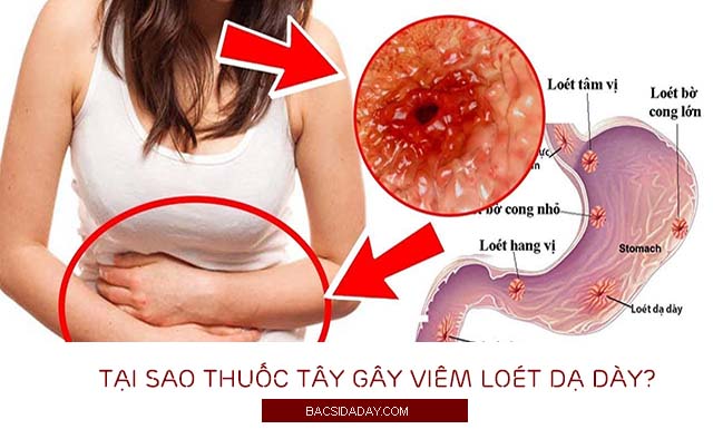 viêm loét dạ dày khi dùng thuốc