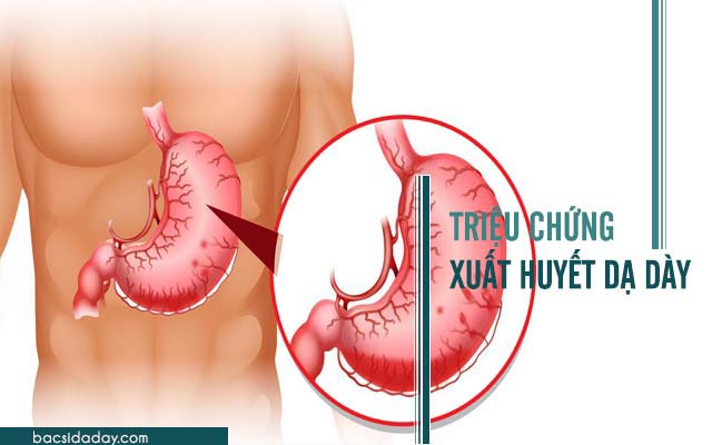 triệu chứng xuất huyết dạ dày