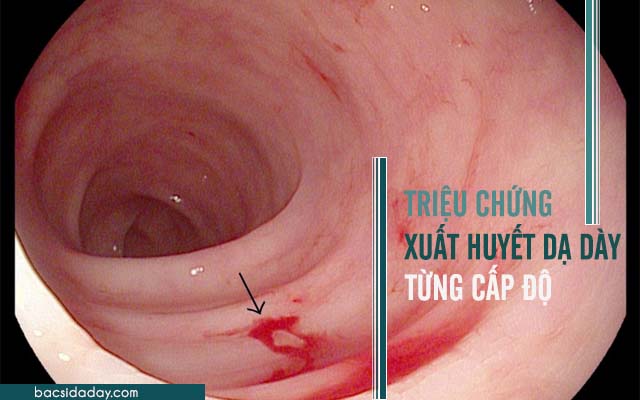 triệu chứng chảy máu dạ dày