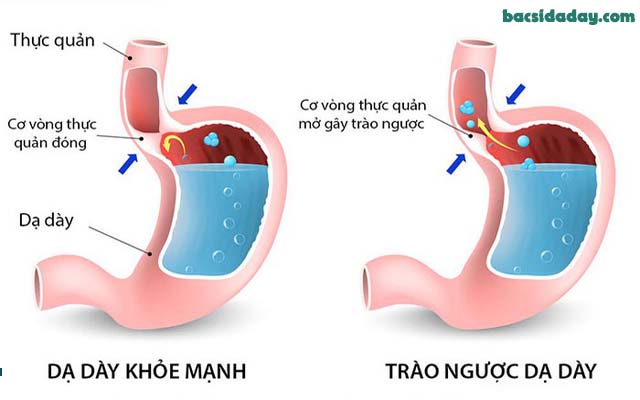 nguyên nhân gây trào ngược dạ dày