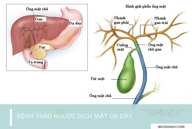 trào ngược dịch mật dạ dày