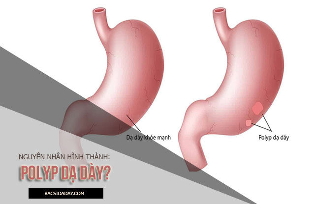 nguyên nhân gây bệnh polyp dạ dày