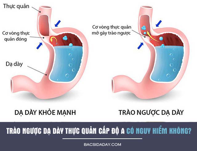 Trào ngược dạ dày thực quản cấp độ A