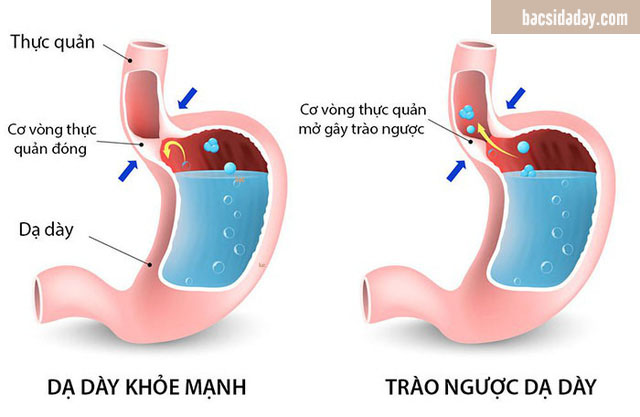 chữa trào ngược dạ dày bằng đông y