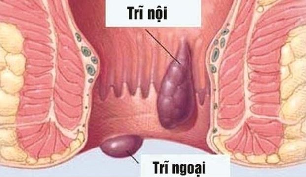 tim-hieu-ve-benh-tri