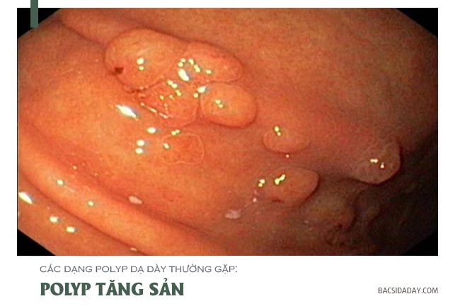 polyp tăng sản