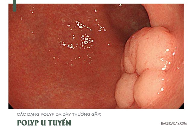 các dạng polyp dạ dày