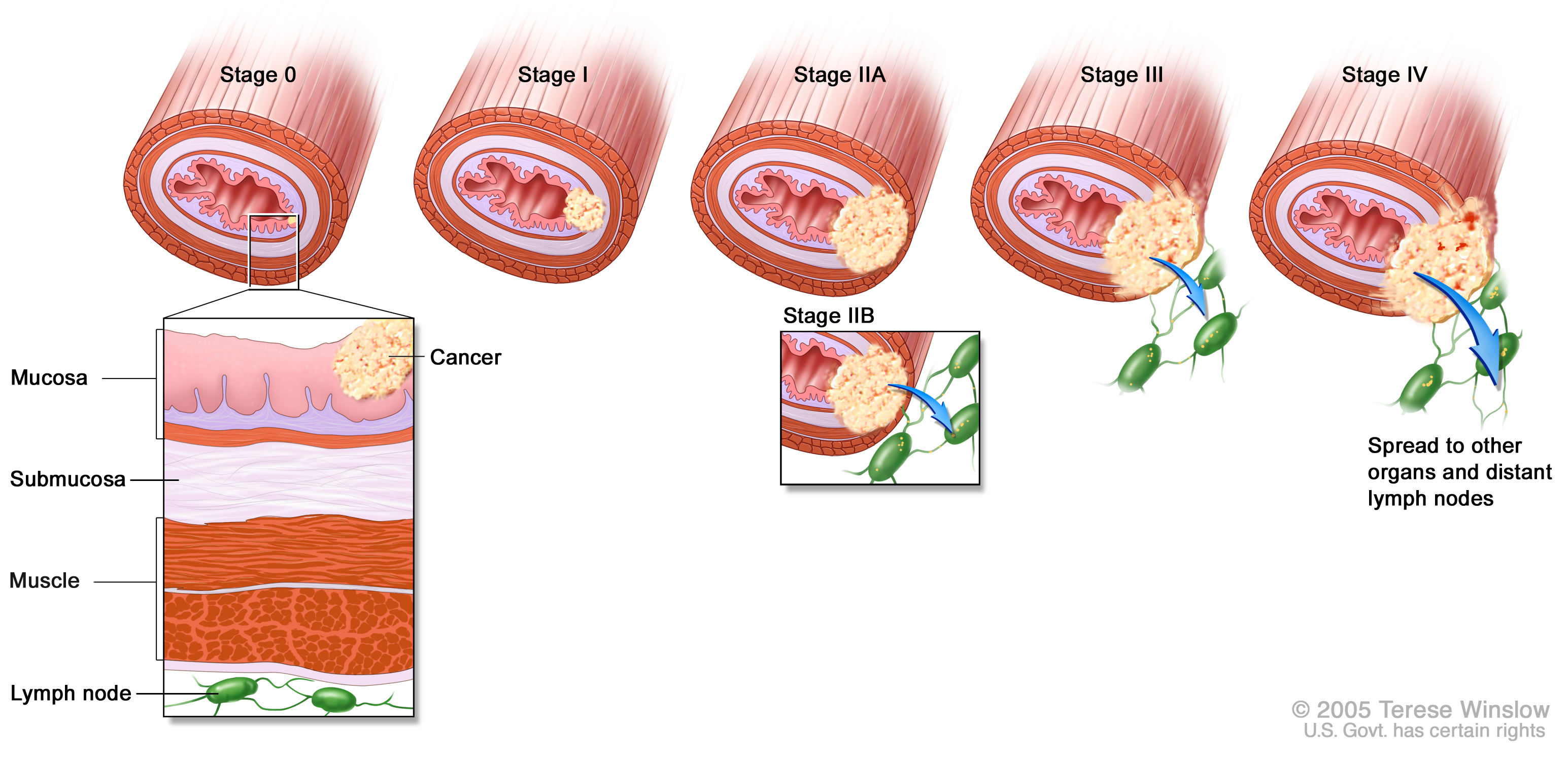 Рак пищевода степени. Опухоли пищевода классификация. Стадии развития онкологии. Опухоли гортани классификация TNM.