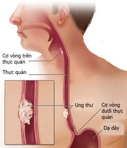 nhan-biet-dau-hieu-benh-ung-thu-thuc-quan