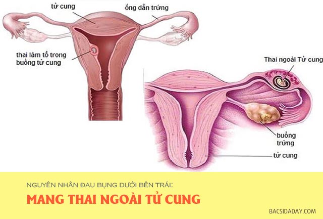 đau bụng dưới bên trái là bệnh gì