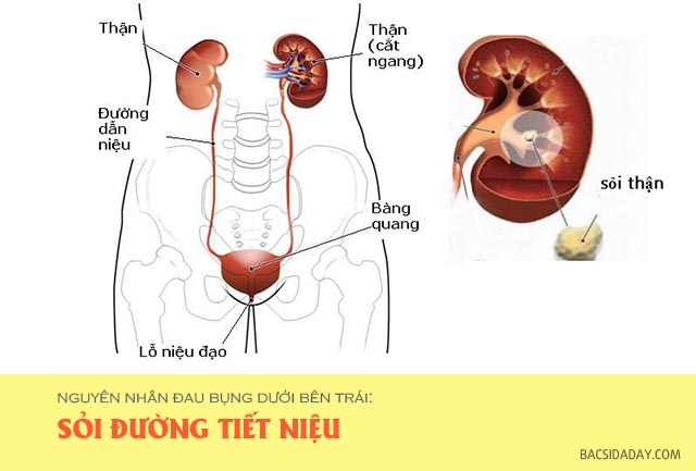 Nguyên nhân của hiện tượng đau bụng dưới bên trái
