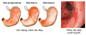 phuong-phap-dieu-tri-viem-hang-vi-da-day-o-tre-em