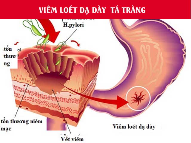 Vi khuẩn HP gây viêm loét dạ dày tá tràng