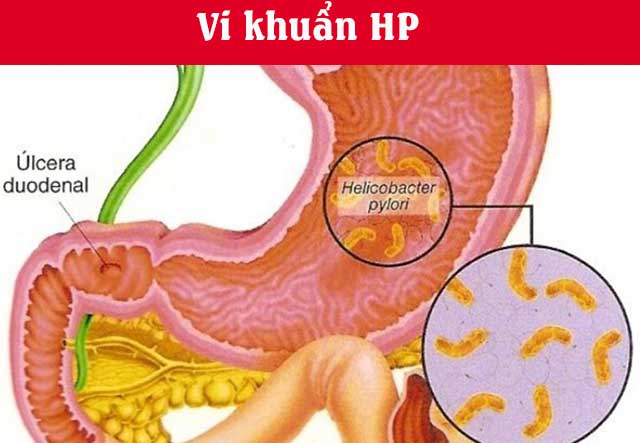 vi khuẩn HP là gì