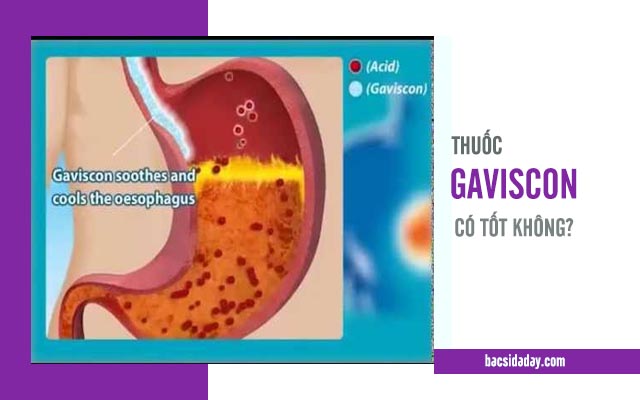 Thuốc trị trào ngược dạ dày Gavisson 