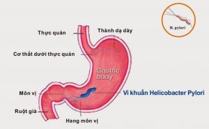 Vi khuẩn Hp dạ dày có ảnh hưởng tới thai nhi không? -1