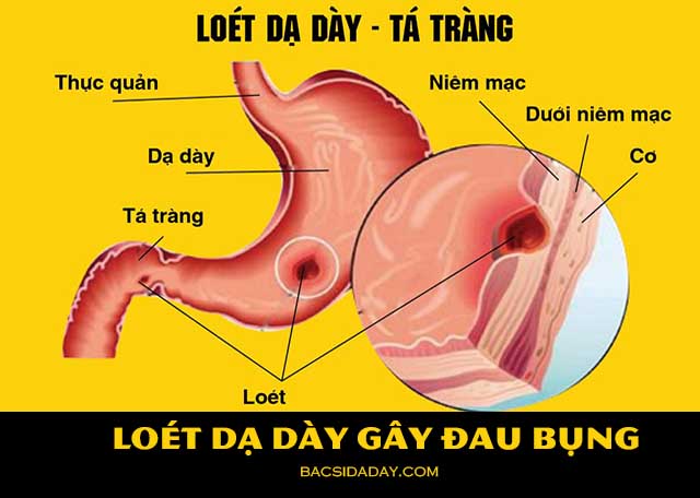 nguyên nhân gây đau bụng