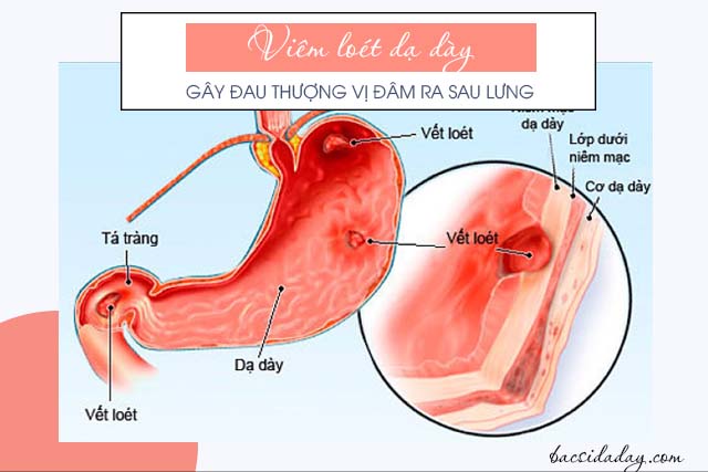 Đau thượng vị lan ra sau lưng