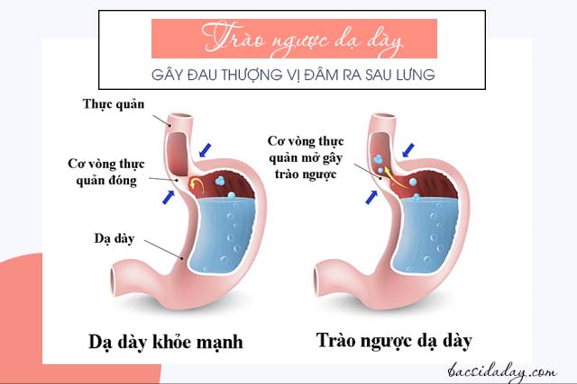 đau thượng vị đâm ra sau lưng