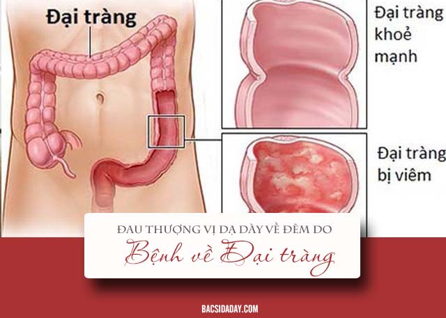 đau thượng vị về đêm và gần sáng