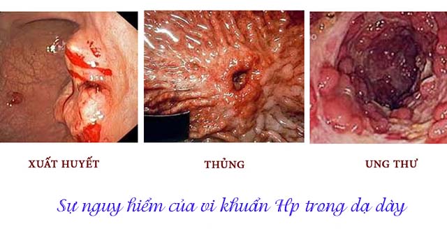 Biến chứng do vi khuẩn Hp trong dạ dày