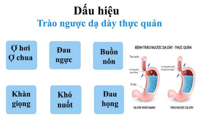 trào ngược dạ dày gây ợ chua khó chịu