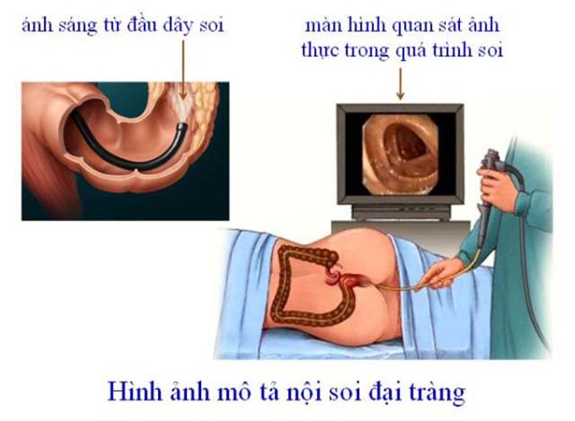 Nội soi đại tràng chẩn đoán xuất huyết dạ dày