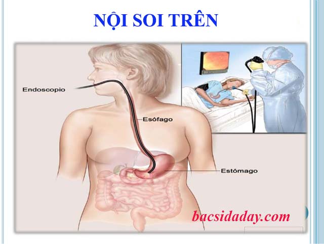 Nội soi trên chẩn đoán xuất huyết dạ dày