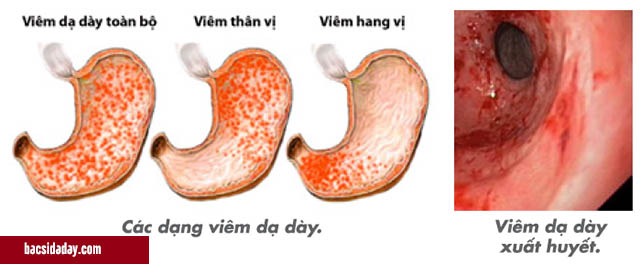 xuất huyết niêm mạc dạ dày