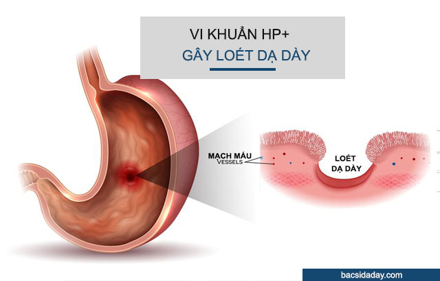 Vi khuẩn Hp dương tính