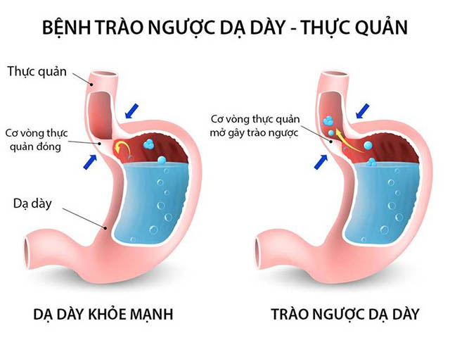 ho trào ngược dạ dày