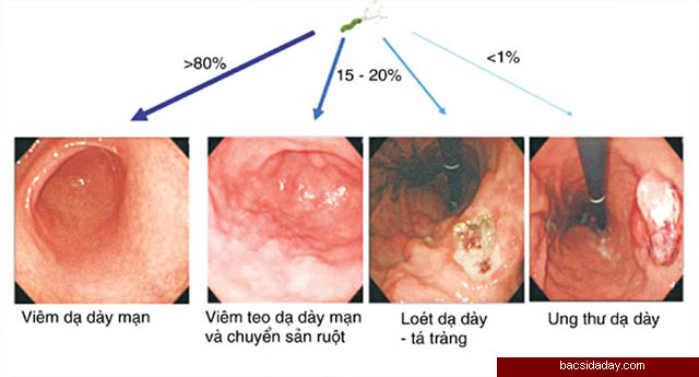 Vi khuẩn Hp có nguy hiểm không?