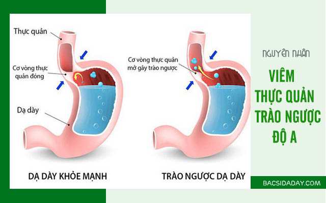 trào ngược dạ dày thực quản độ a