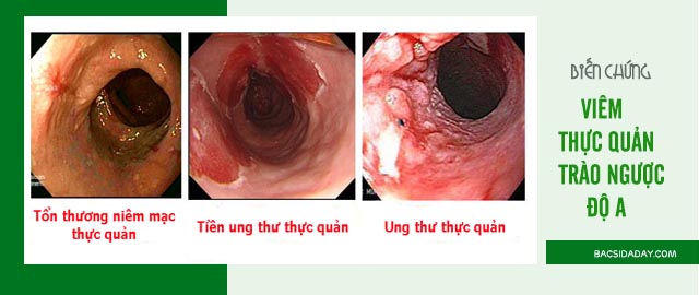 viêm thực quản trào ngược độ a là gì