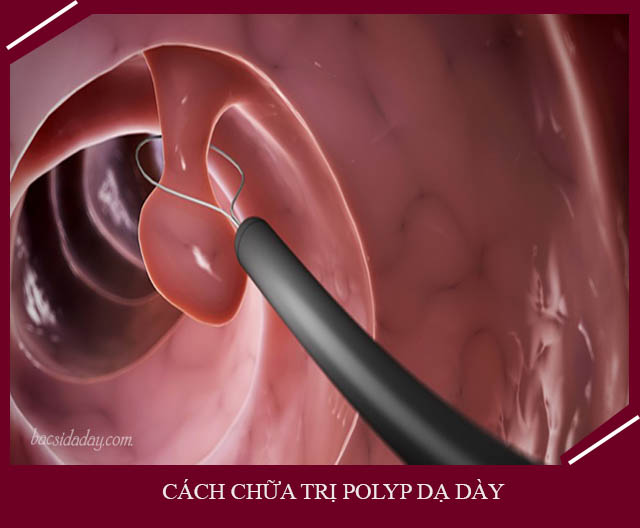 cách điều trị polyp dạ dày 