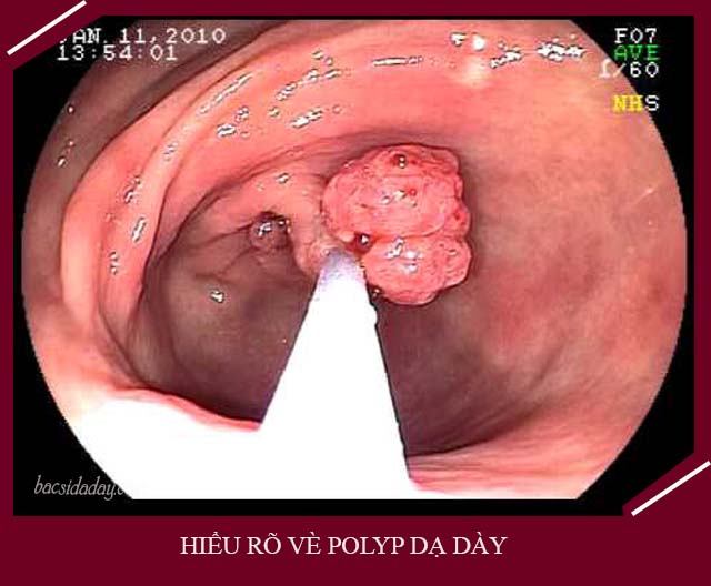 Polyp dạ dày là gì