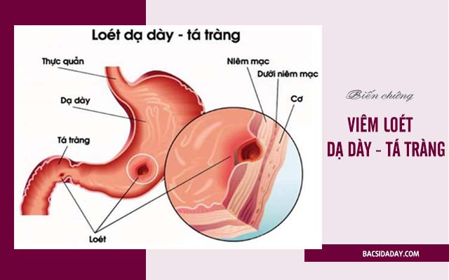 biến chứng của viêm loét dạ dày