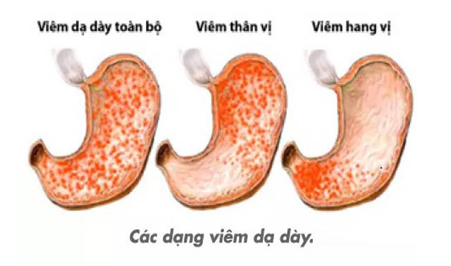 mẹo chữa viêm xung huyết hang vị dạ dày