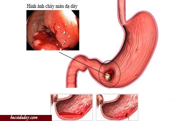 Phòng ngừa xuất huyết dạ dày